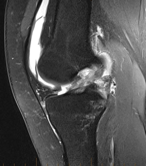acl1