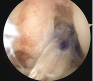acl3