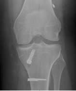 acl4
