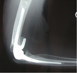 elbow3