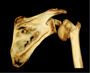 fracture1