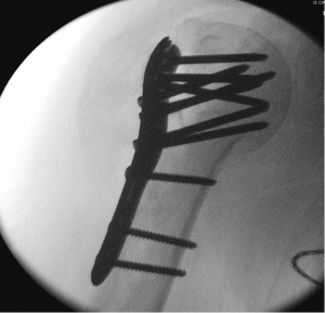fracture2