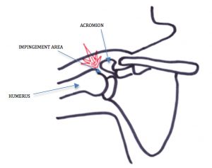impingement1