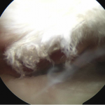 impingement2