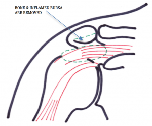 impingement3