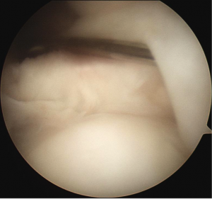 Slap tear