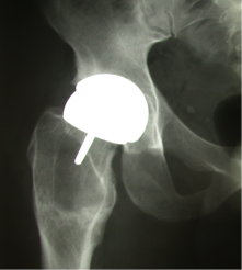 metal on metal hip with bone cysts
