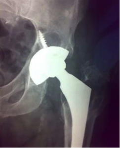 XRay showing ‘lysis’ near the screws above the cup