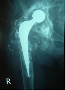 loose cup and stem revised with larger metal components and bone graft