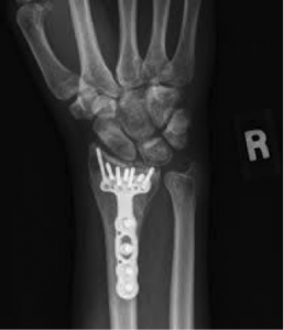 wrist2